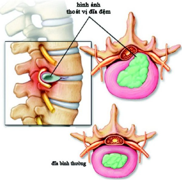 Thoát vị đĩa đệm
